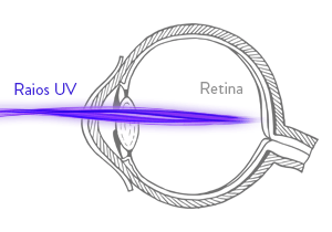 Ilustração de um olho com a incidência de raios UV. Os raios UV incidem diretamente no fundo da retina.