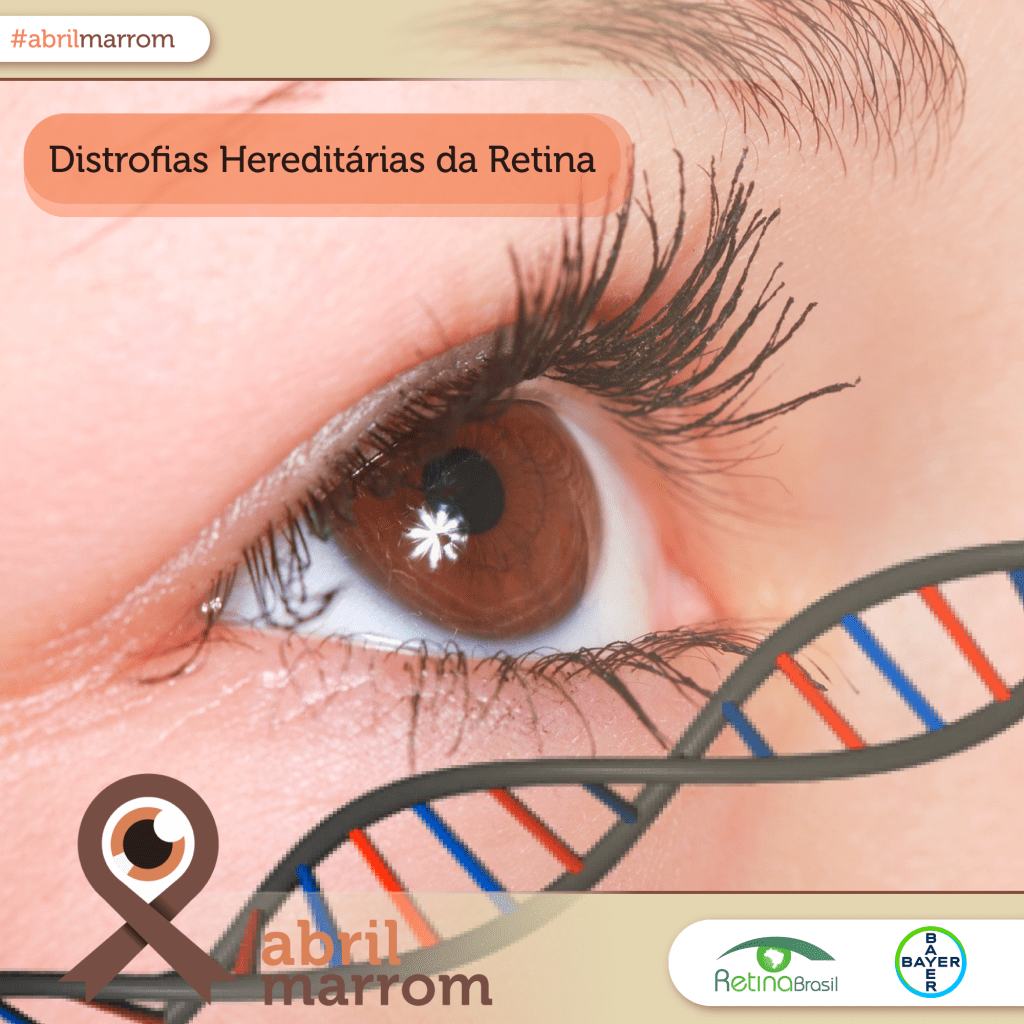 Retina: 3 doenças hereditárias e raras. - CBCO