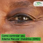 foto do olho de uma mulher de meia idade. A mulher tem pele e olhos negros. Está escrito: "Como controlar o seu Edema MAcular Diabético (EMD)" e há a logo da Retina Brasil.