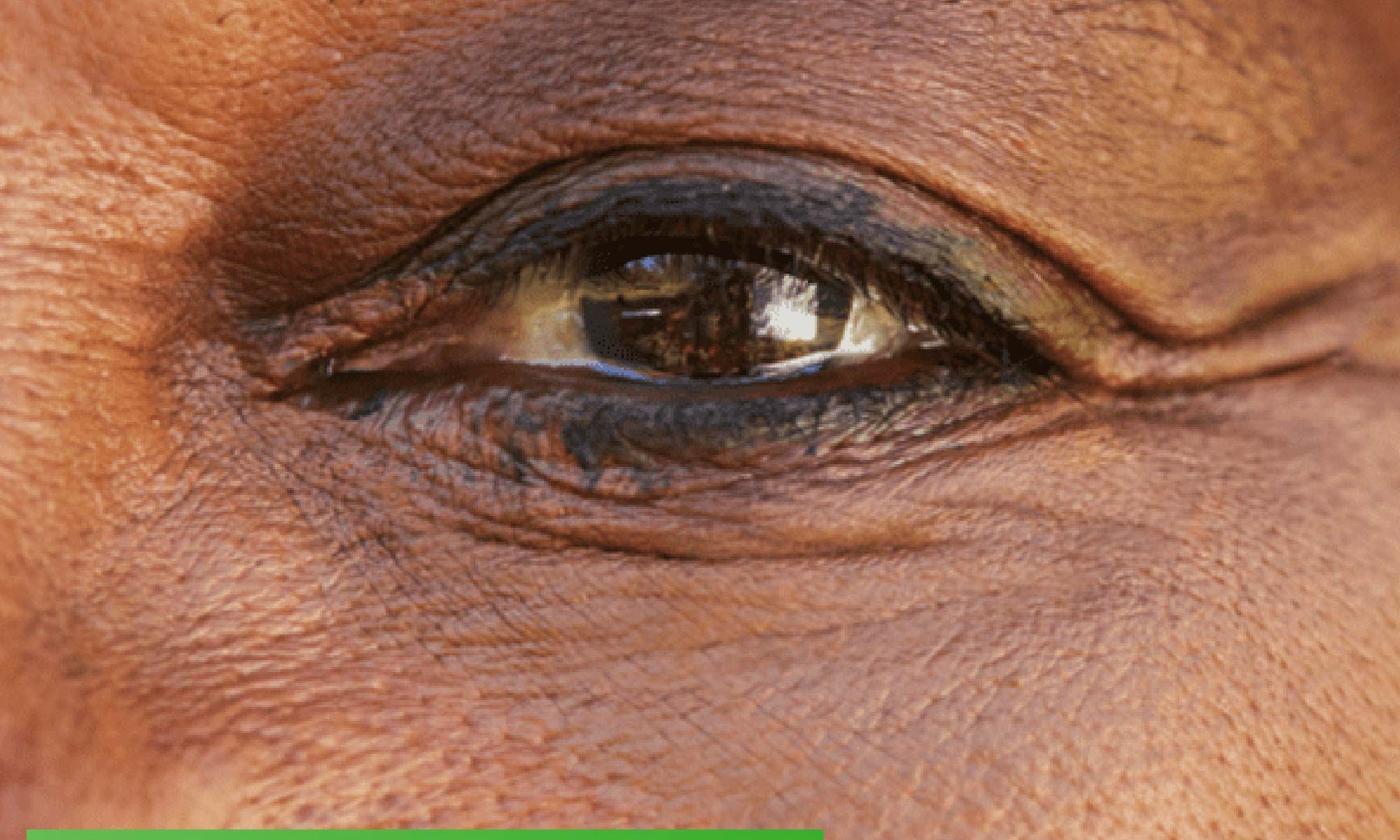 foto do olho de uma mulher de meia idade. A mulher tem pele e olhos negros. Está escrito: "Como controlar o seu Edema MAcular Diabético (EMD)" e há a logo da Retina Brasil.